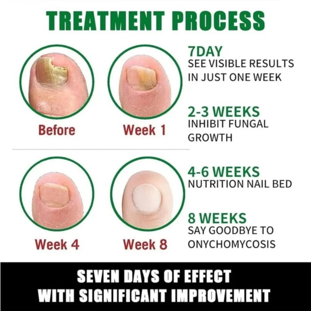 JAYSUING Nail Fungus Treatment - NEW IN SEALED BOX - fingernail toenail